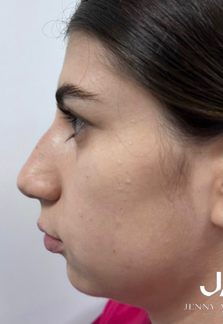 Después - Rinoplastia femenina