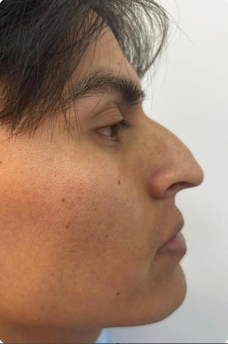 Antes - Rinoplastia masculina