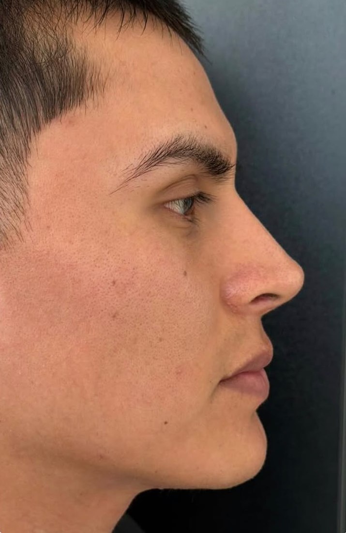 Después - Rinoplastia masculina
