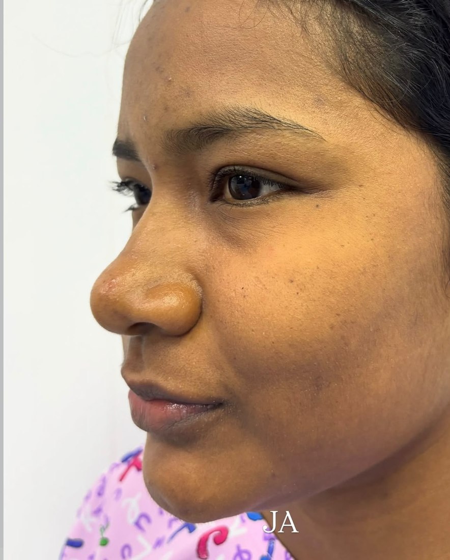 Antes - Rinoplastia femenina